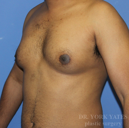 Gynecomastia before photo