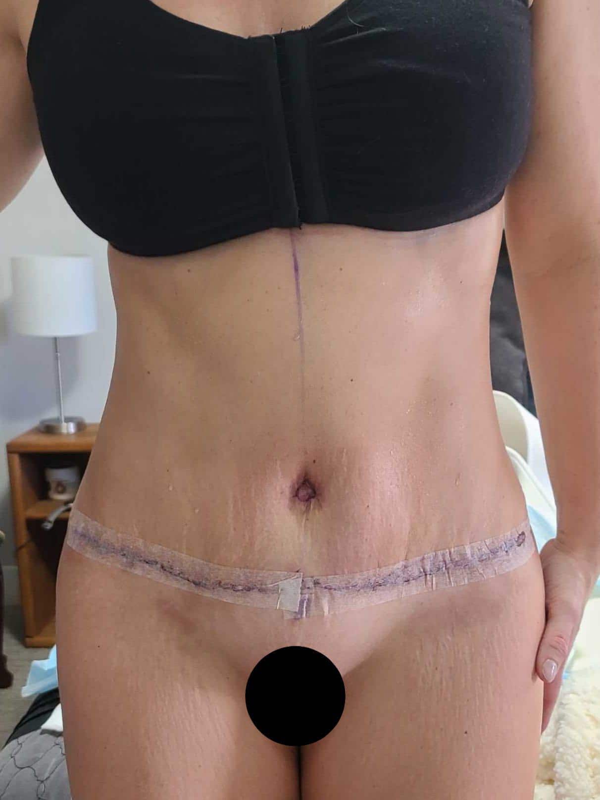 Implant Revision result at Dr. York Yates Plastic Surgery