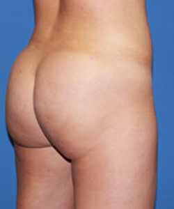 Bbl result at Dr. York Yates Plastic Surgery
