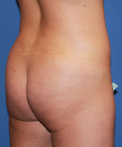 Bbl before photo