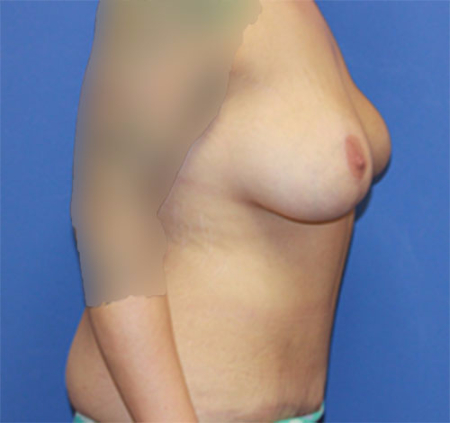 Body Contouring result at Dr. York Yates Plastic Surgery