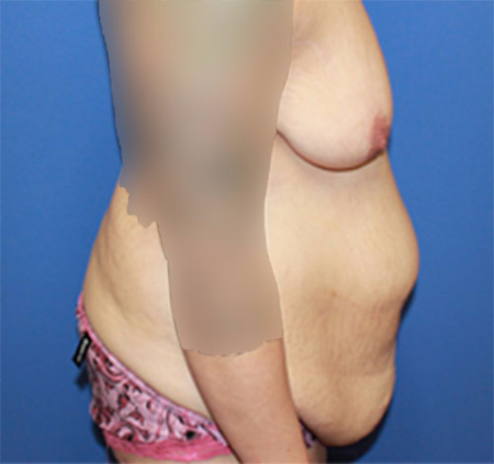 Body Contouring before photo