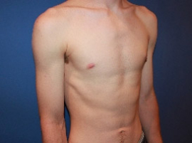 Gynecomastia result at Dr. York Yates Plastic Surgery