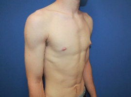 Gynecomastia before photo