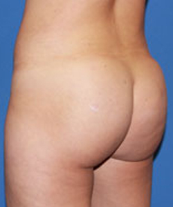 Dr. York Yates Plastic Surgery bbl after — Tanner Clinic -Layton Parkway, UT