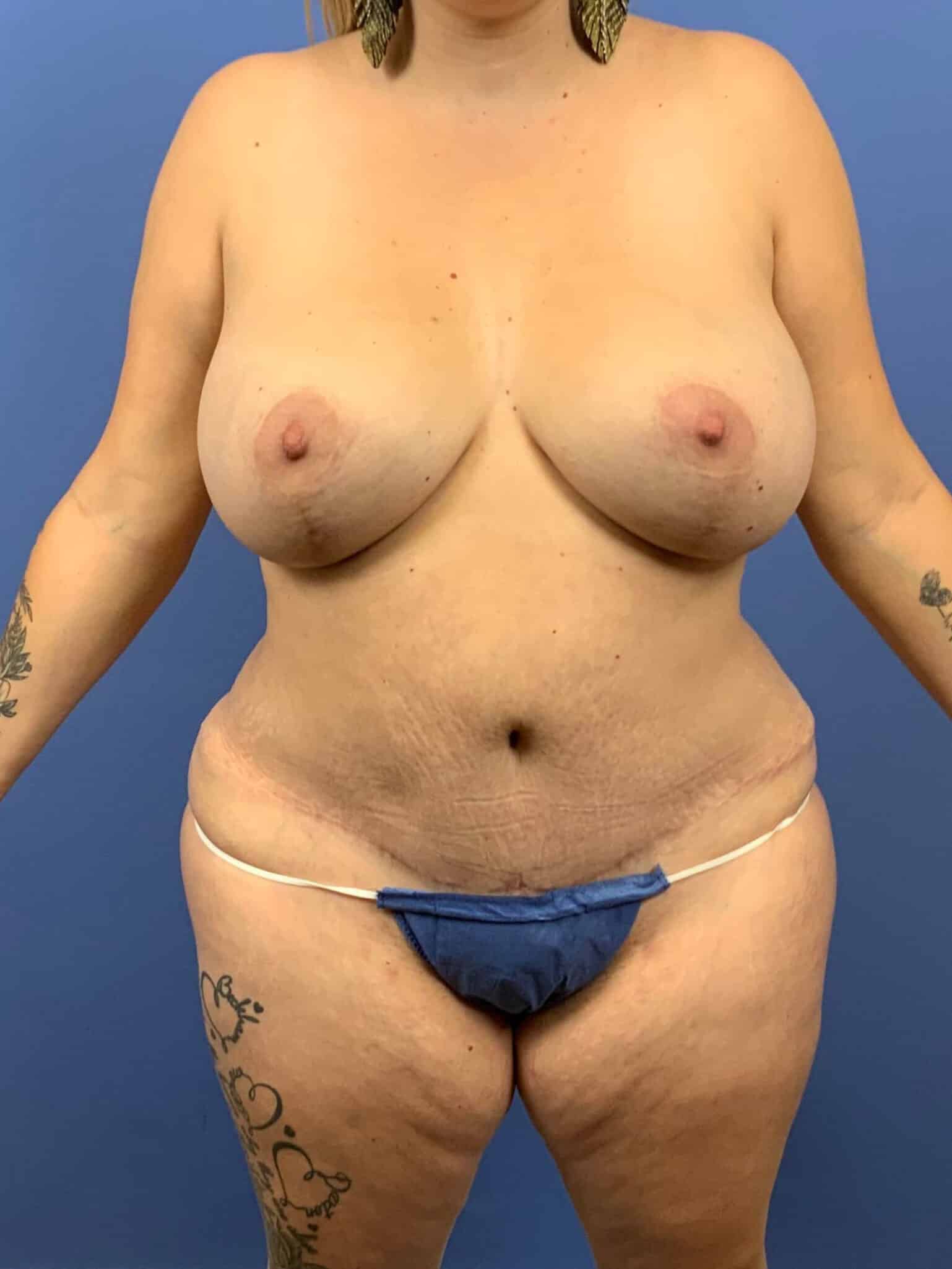 Breast Lift result at Dr. York Yates Plastic Surgery
