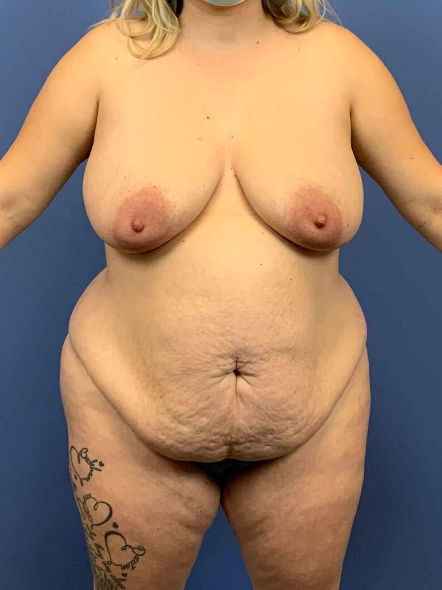 Breast Lift before photo