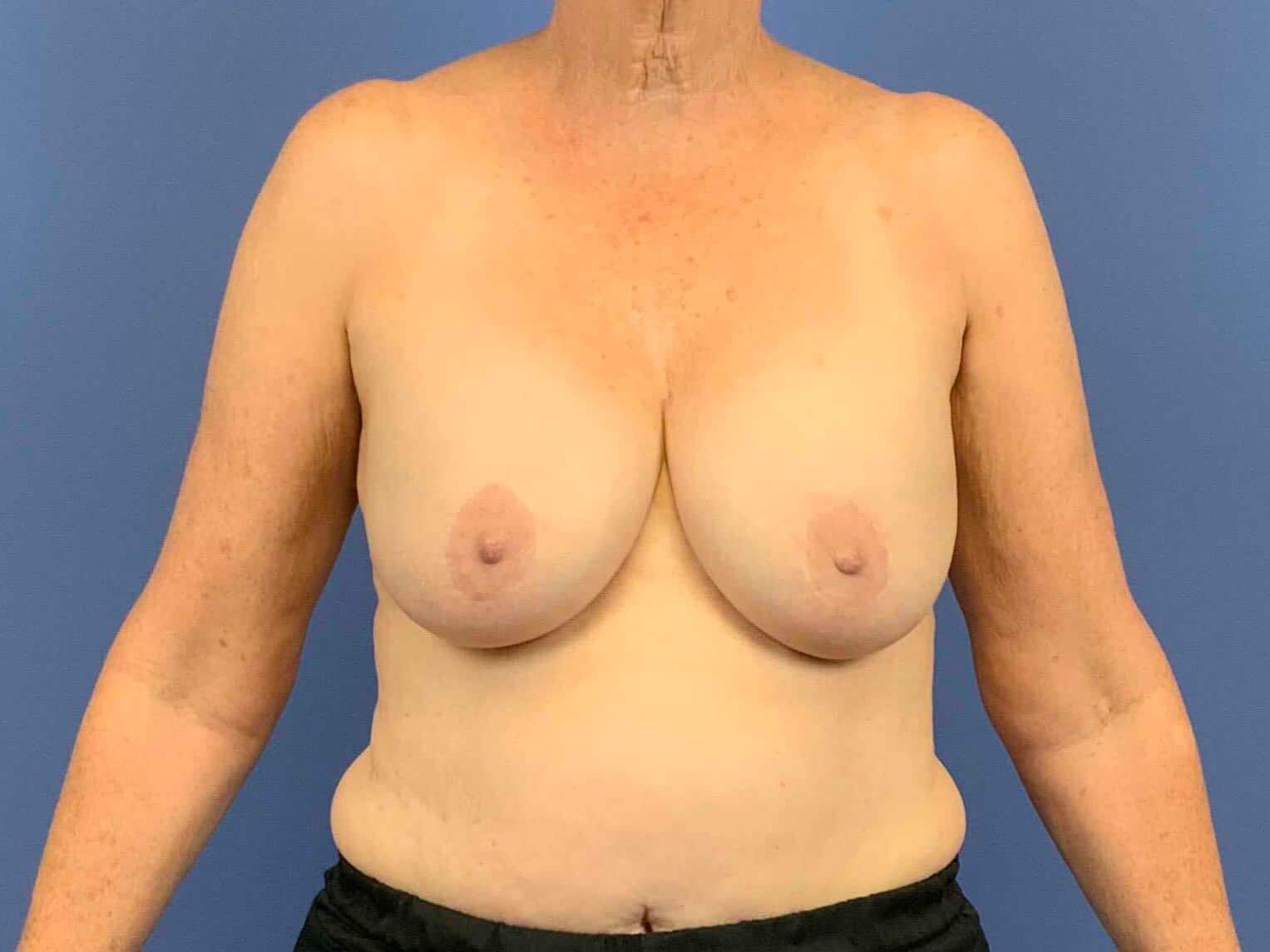 Breast Implant Removal before photo