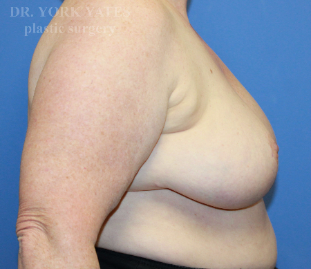 Breast Reduction result at Dr. York Yates Plastic Surgery