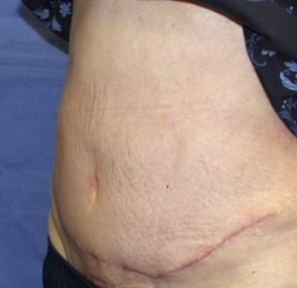 Tummy Tuck result at Dr. York Yates Plastic Surgery