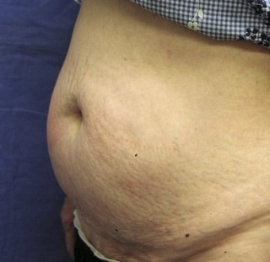Tummy Tuck before photo