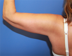 Body Contouring result at Dr. York Yates Plastic Surgery