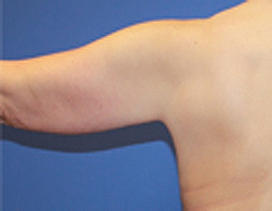 Body Contouring before photo