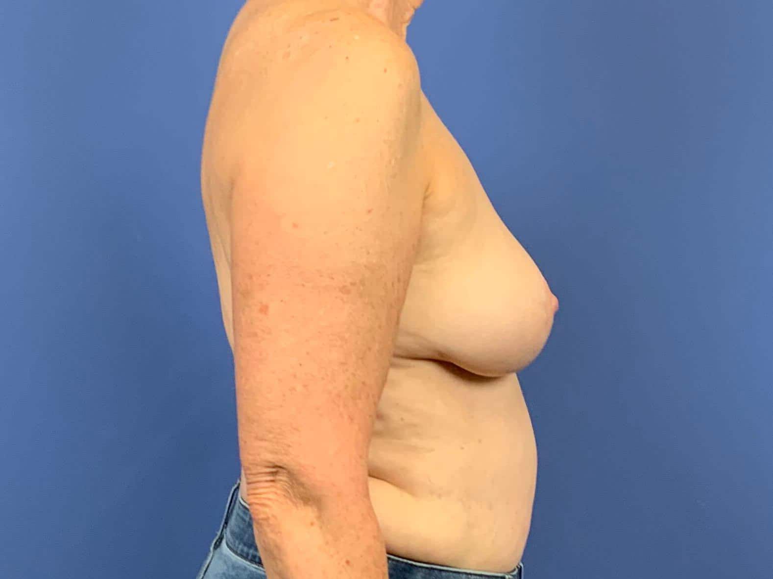 Breast Implant Removal result at Dr. York Yates Plastic Surgery