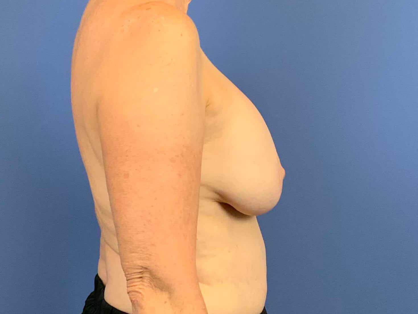 Breast Implant Removal before photo