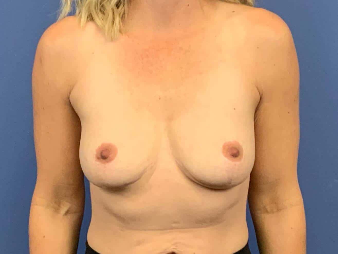 Breast Implant Removal result at Dr. York Yates Plastic Surgery