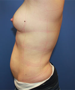 Tummy Tuck before photo