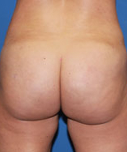 Bbl result at Dr. York Yates Plastic Surgery