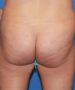 Bbl before photo