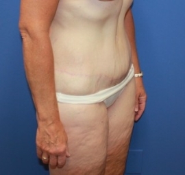 Body Contouring result at Dr. York Yates Plastic Surgery