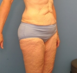 Body Contouring before photo