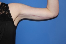 Dr. York Yates Plastic Surgery arm lift after — Tanner Clinic -Layton Parkway, UT