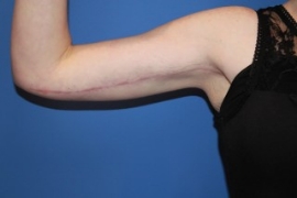 Arm Lift result at Dr. York Yates Plastic Surgery