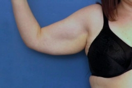 Arm Lift before photo