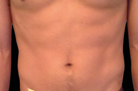 Dr. York Yates Plastic Surgery emsculpt after — Tanner Clinic -Layton Parkway, UT