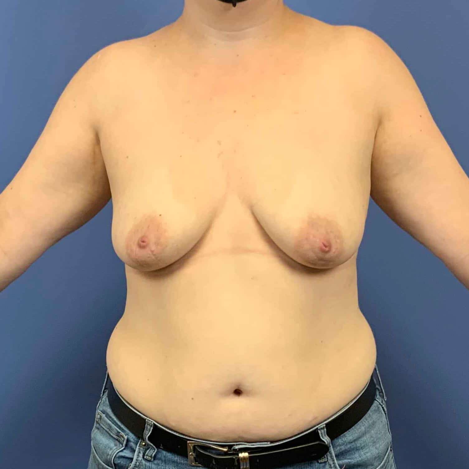Breast Lift before photo