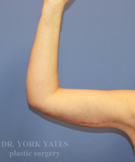Arm Lift result at Dr. York Yates Plastic Surgery