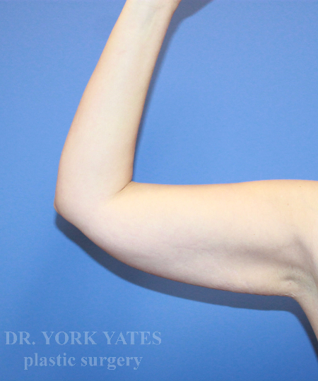 Arm Lift before photo