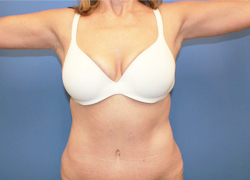 Arm Lift result at Dr. York Yates Plastic Surgery
