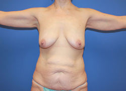 Arm Lift before photo