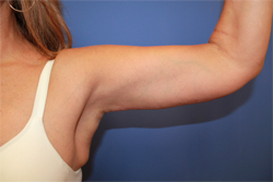 Body Contouring result at Dr. York Yates Plastic Surgery