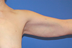 Body Contouring before photo