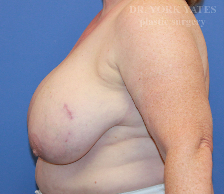 Breast Reduction before photo