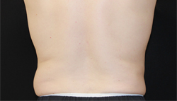 Coolsculpting result at Dr. York Yates Plastic Surgery