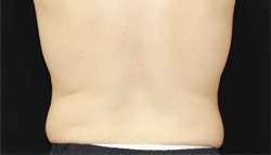 Coolsculpting before photo