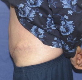 Dr. York Yates Plastic Surgery tummy tuck after — Tanner Clinic -Layton Parkway, UT
