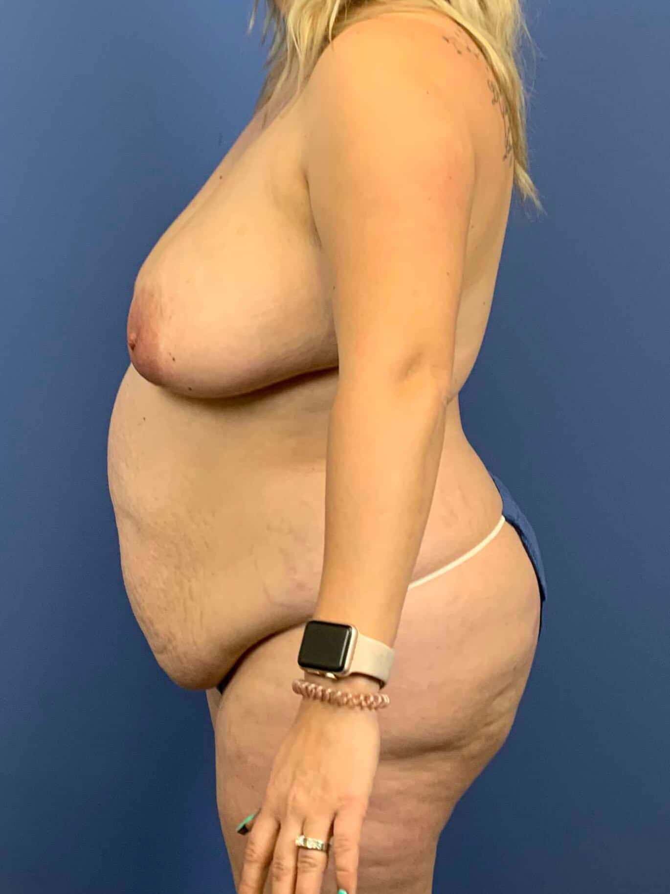 Breast Lift before photo