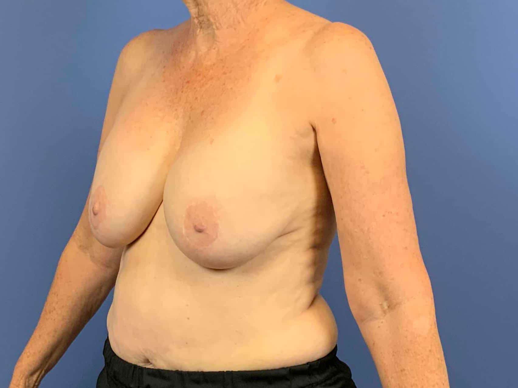 Breast Implant Removal before photo