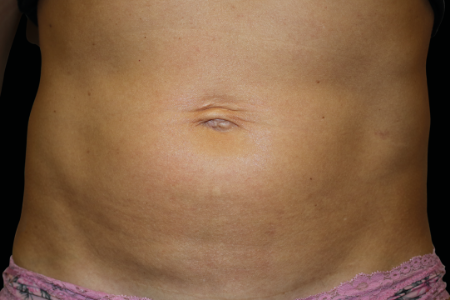 Dr. York Yates Plastic Surgery emsculpt after — Tanner Clinic -Layton Parkway, UT