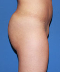 Bbl result at Dr. York Yates Plastic Surgery