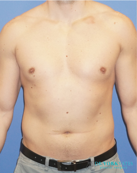 Gynecomastia result at Dr. York Yates Plastic Surgery