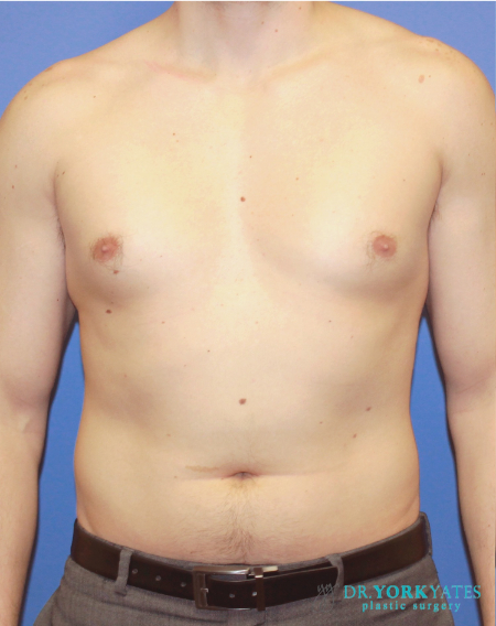 Gynecomastia before photo