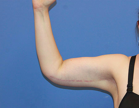Arm Lift result at Dr. York Yates Plastic Surgery