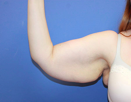 Arm Lift before photo