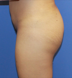Bbl result at Dr. York Yates Plastic Surgery