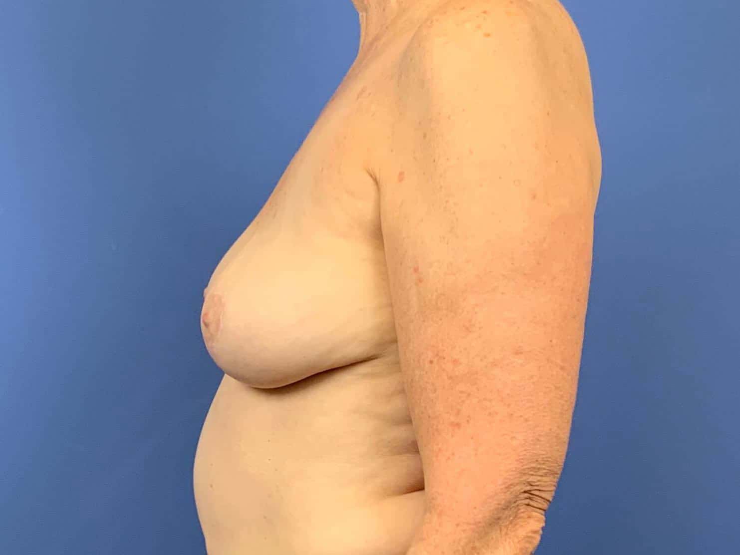 Breast Implant Removal result at Dr. York Yates Plastic Surgery